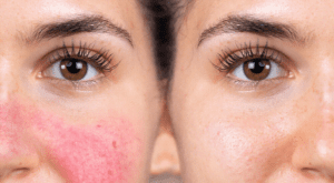 Skin Allergy Treatments