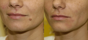 Moles Treatments